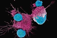 CAR T cell  درمانی موثر برای بیماران مبتلا به لنفومای سلولی مانتل