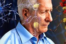 کشف جدیدی در رابطه با تغییر هویت سلول‌های نورونی در بیماران مبتلا به آلزایمر