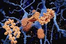 چگونه کلسترول مغز پلاک‌های آلزایمر را تنظیم می کند؟