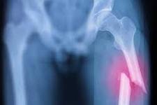 تغییرات سلولی دخیل در ترمیم شکستگی های استخوان