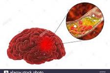 استروژن مغزی برای حفاظت از مغز در زمان کمبود اکسیژن حیاتی است