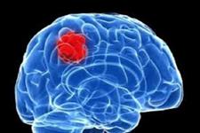 تومورهای مغزی ممکن است در منطقه ای از مغز منشا بگیرند که مجزا از جایی است که منجر به یک بیماری کشنده می شود