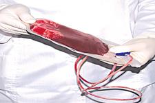 بیست و چهارمین عمل پیوند سلول های بنیادی با خون بندناف