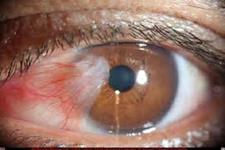 نیکوتین آمید می تواند به درمان بیماری چشمی فیبروز و کاهش نابینایی کمک کند