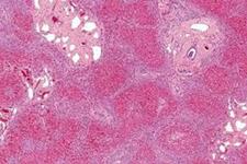نشان دادن اثر سلول های B در سلول درمانی فیبروز