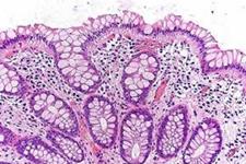 از دست رفتن سلول های گابلت روده ای بعد از پیوند سلول های بنیادی موجب مرگ می شود