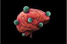 یک استراتژی درمانی جدید برای شکل بدخیم سرطان مغز