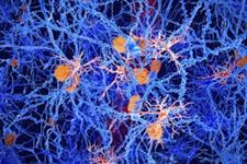 ژن مرتبط با بیماری آلزایمر چه تأثیری بر سلول های ایمنی مغز می گذارد