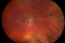 استفاده از سلول های بیماران برای تست ژن درمانی و درمان یک بیماری چشمی نادر