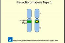 شناسایی یک هدف جدید برای مقابله با سرطان مغزی نوروفیبروماتوز نوع یک (NF1)