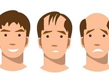 ارتباط ژن‌های نادر با ریزش موی مردانه ارثی 