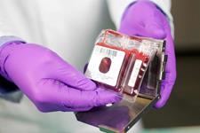 استفاده سلول‌های بنیادی خون بندناف در بیماری‌های نقص ایمنی
