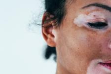  FDA اولین درمان خانگی برای رنگدانه پوست در بیماران ویتیلیگو را تایید کرد