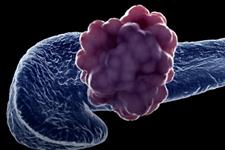 سلول‌های مقاوم به استرس باعث شروع تومور در سرطان پانکراس می‌شوند