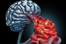 یک پروتئین خاص ممکن است روند بقای بیماران دچار خونریزی مغزی را تغییر دهد