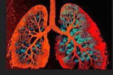مهندسی سلول‌های بنیادی ریه برای پیوند به ریه‌های آسیب دیده