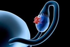ایمونوتراپی جدید نویدبخش سرطان تخمدان 