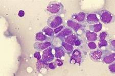 چگونه تومورها سلول‌های ایمنی را دستکاری می‌کنند