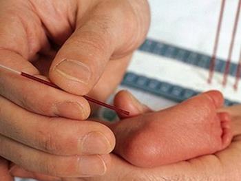 غربالگری سندرم شکننده X در نوزادان تازه متولد شده ممکن شد