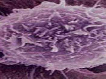 سلول های بنیادی پرتوان القایی  درمان جدیدی برای بیماری هانتینگتون