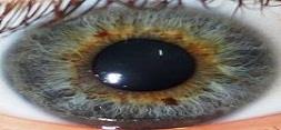 رنگ چشم، شاخصی برای خطر ابتلا به بیماری های پوستی 