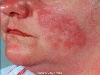 بیماری لوپوس همزمان در پوست و مفاصل می تواند بروز کند