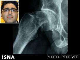یافته‌های محقق ایرانی درباره تأثیر زمان جراحی بر بهبود شکستگی لگن