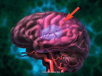 گامی به سوی درمان سکته مغزی بر پایه سلول های بنیادی