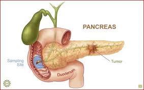 کشف داروی ضد سرطان پانکراس 