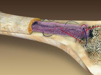 ترمیم استخوان آسیب دیده توسط سازه مهندسی شده بافت برپایه سلول بنیادی 