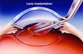 تصویب ژل درزگیر(Sealant) برای جراحی های چشم