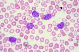 موفقیت داروی جدید سرطان خون در مطالعات بالینی
