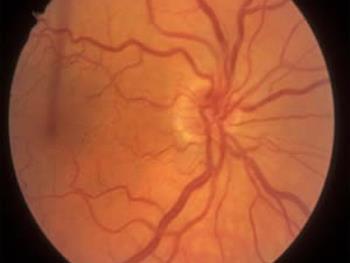 عدم تأثیرسلول های بنیادی بر درمان هیپوپلازی عصب بینایی در کودکان 