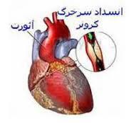 بیماری عروق کرونری غیر انسدادی بین 28 الی 44 درصد با افزایش خطر حمله قلبی همراه است