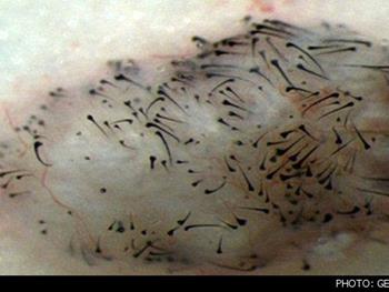   درمان کچلی موشها با سلول بنیادی انسان