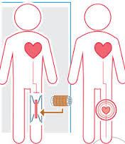 طراحی مینی قلب هایی که در هر جایی از سیستم گردش خون استفاده شوند