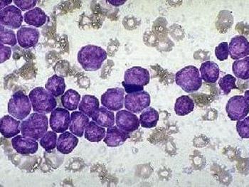 حذف سلول های بنیادی سرطانی و درمان لوکمیا