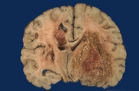 سلول های بنیادی انسانی اسیب های ایجاد شده به وسیله پرتودرمانی برای سرطان مغز را درمان می کنند