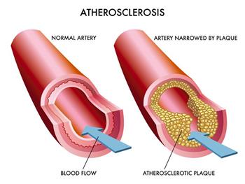 نقض باورهای اساسی در مورد آرترواسکلروزیس