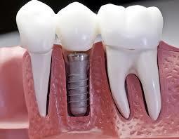 ایمپلنت های دندانی بیوهیبرید که عملکردهای فیزیولوژیک دندان را احیا می کنند