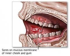 ارتباط بین پاسخ های التهابی نوتروفیلی و پراکنش سرطان دهان