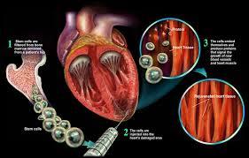 کاهش مرگ ناشی از بیماری های قلبی به کمک سلول درمانی 