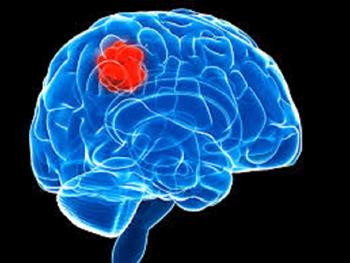 هدفی جدید روی تومورهای مغزی که آن ها را برای سلول های ایمنی قابل شناسایی می سازد