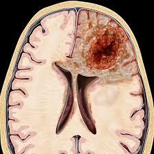 ارتباط بین تکوین مغز و سرطان