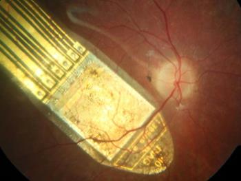 تست ایمپلنت شبکیه مبتنی بر سلول های بنیادی برای دلیل اصلی از دست رفتن بینایی