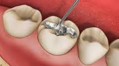 تحریک سلول های بنیادی برای ترمیم دندان ها