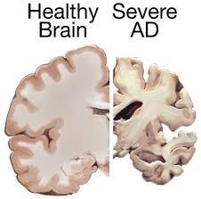 ساختار منحصربفرد آمیلوئید عروق خونی مغزی نشانه هایی از تکوین آلزایمر