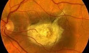 بازبرنامه ریزی سلولی می تواند منجر به درمان بیماری های چشمی شود