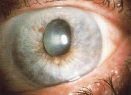 درمان گلوکوم چشم از روش "سیستم مهندسی شده انتقال دارو"