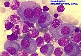پیوند سلول های بنیادی به بیمار مبتلا به مولتیپل میلوما